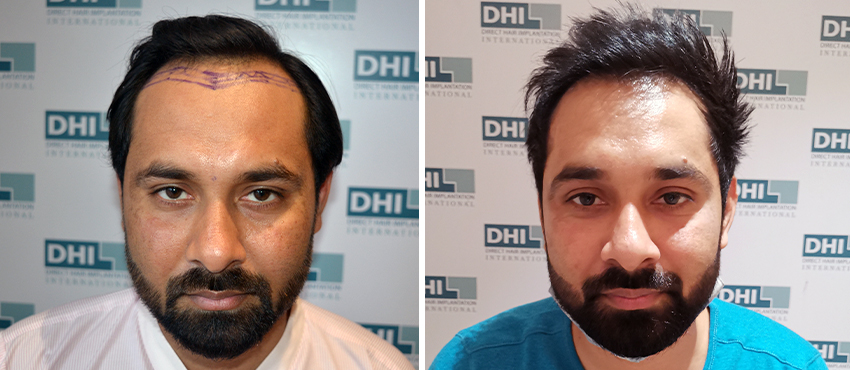 DHI before & after hair transplant results