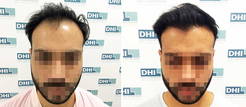 DHI before & after hair transplant results