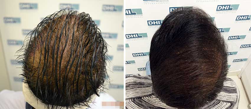 DHI before & after hair transplant results