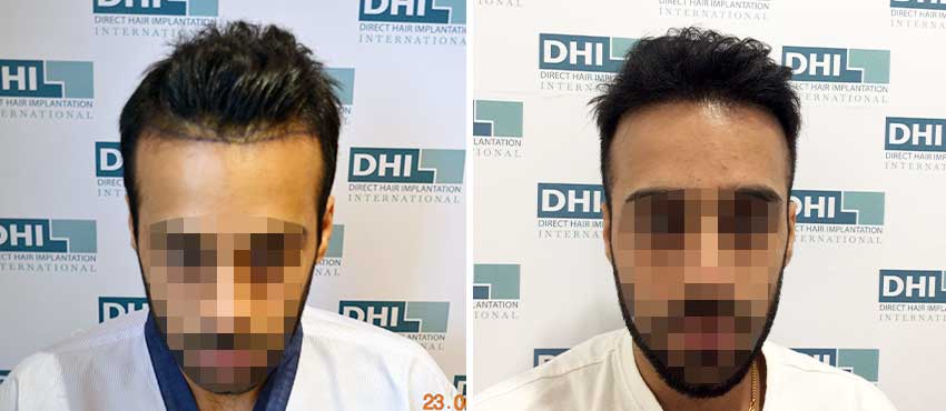 DHI before & after hair transplant results