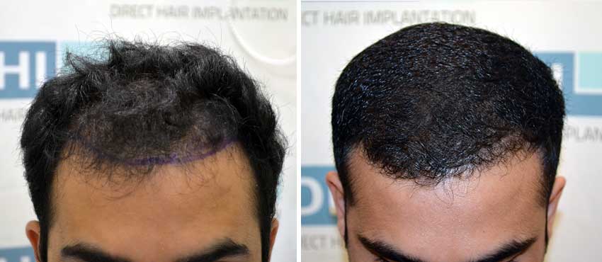 DHI before & after hair transplant results