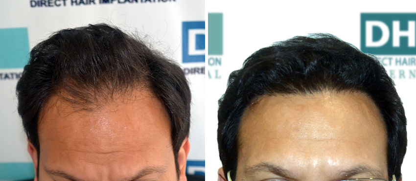 DHI before & after hair transplant results