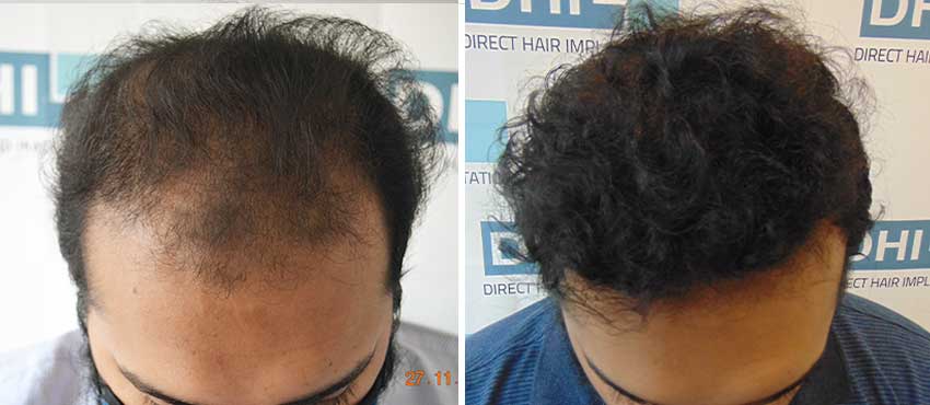 DHI before & after hair transplant results