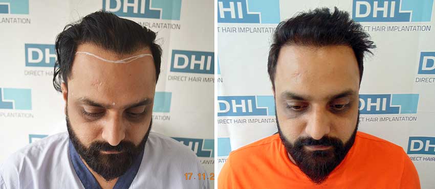 DHI before & after hair transplant results