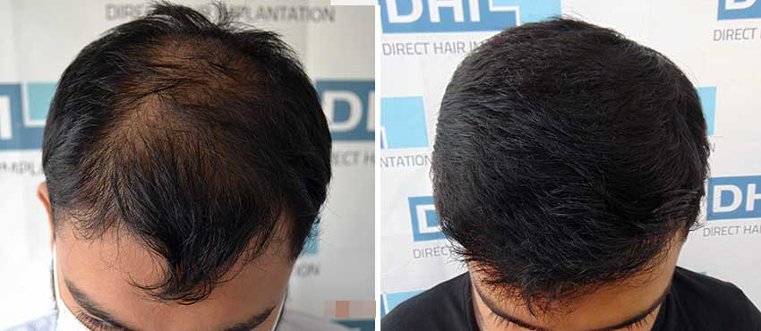 DHI before & after hair transplant results