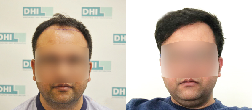 DHI before & after hair transplant results