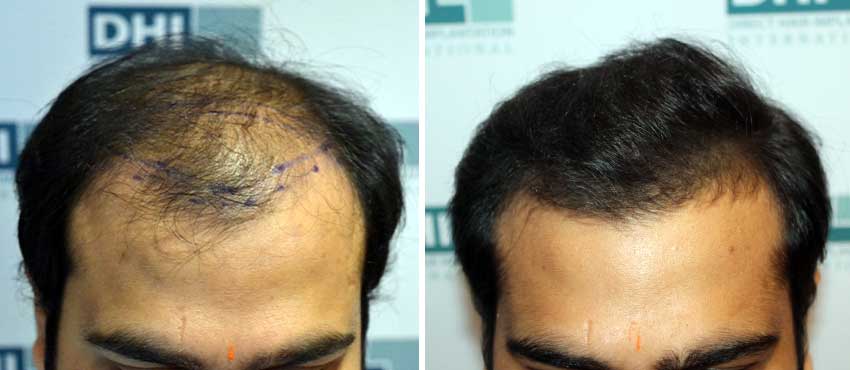 DHI before & after hair transplant results