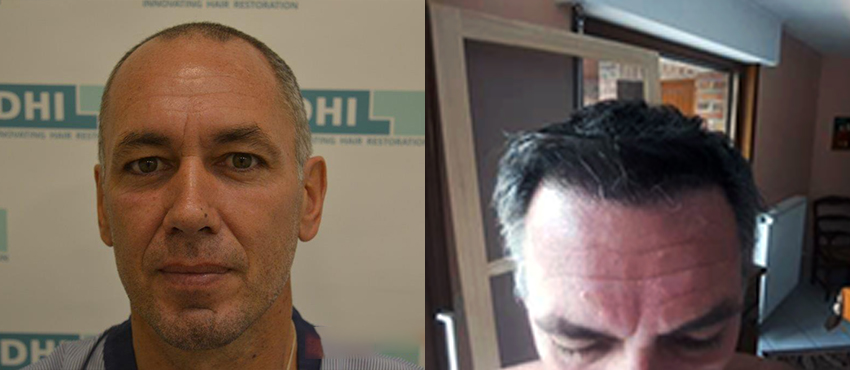 DHI before & after hair transplant results