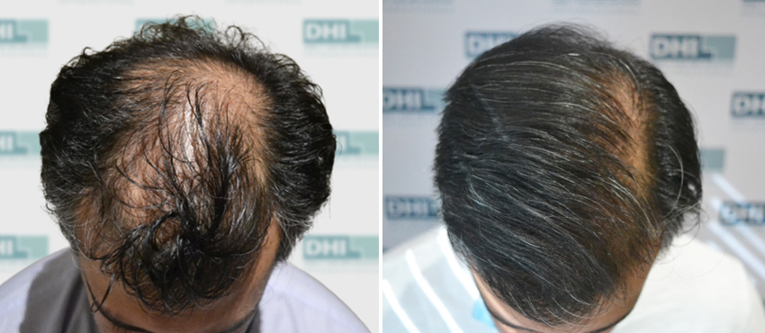 DHI before & after hair transplant results