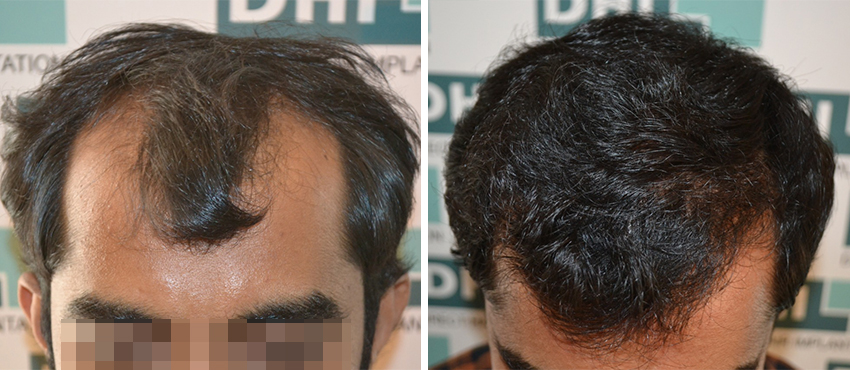 DHI before & after hair transplant results