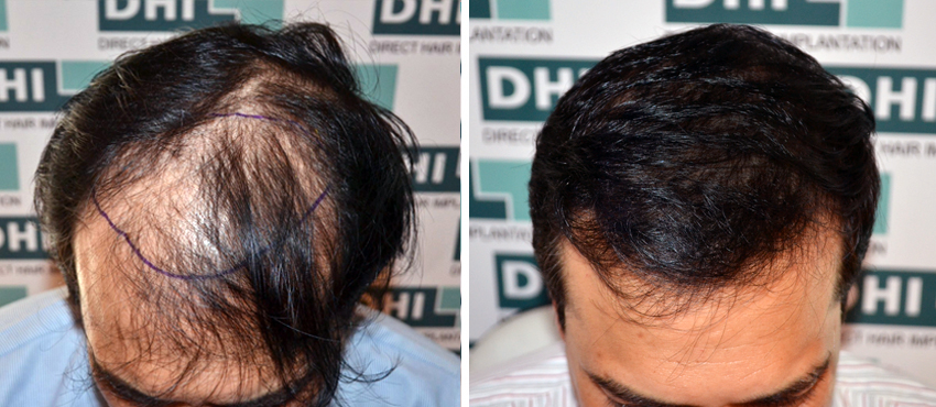 DHI before & after hair transplant results