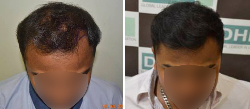 DHI before & after hair transplant results