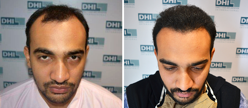 DHI before & after hair transplant results