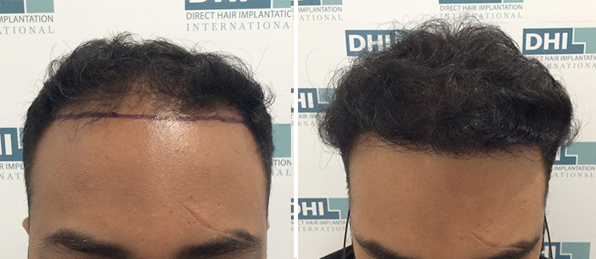 DHI before & after hair transplant results