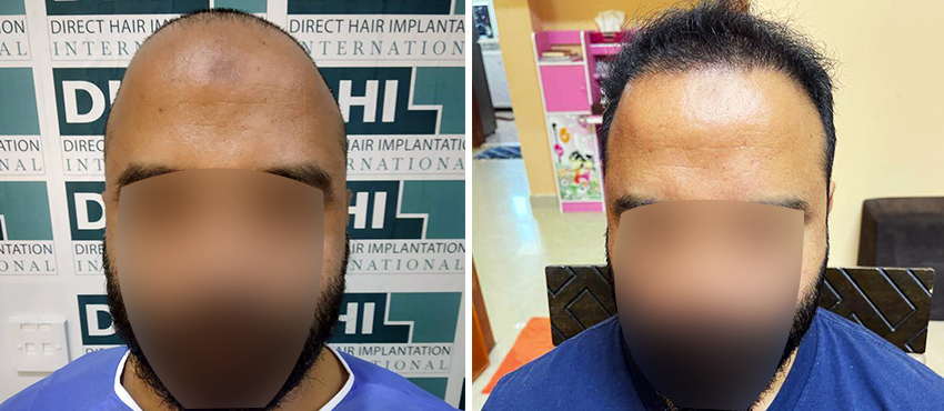 DHI before & after hair transplant results