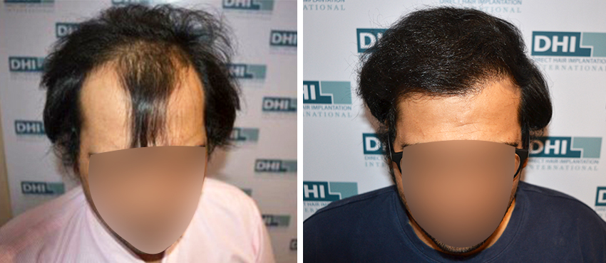 DHI before & after hair transplant results