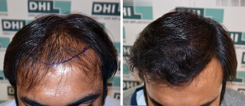 DHI before & after hair transplant results