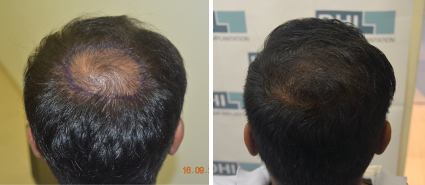 DHI before & after hair transplant results