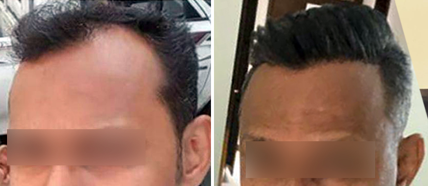 DHI before & after hair transplant results