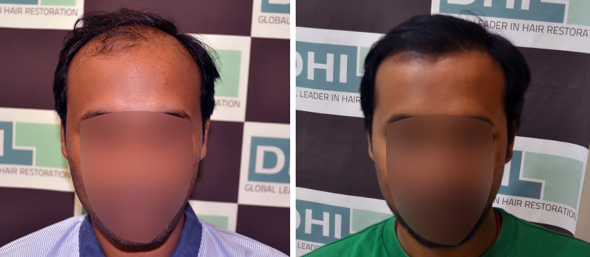 DHI before & after hair transplant results