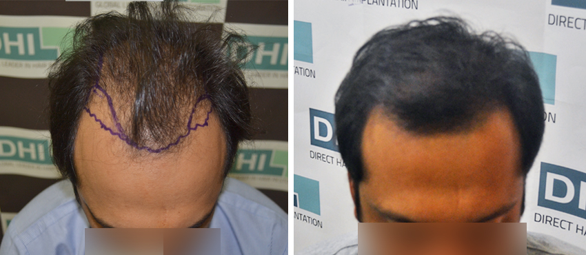 DHI before & after hair transplant results