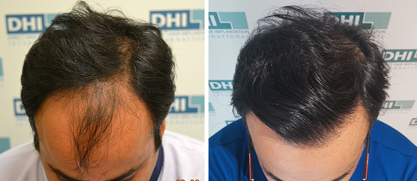 DHI before & after hair transplant results