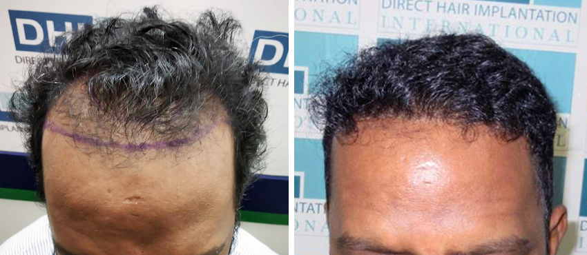 DHI before & after hair transplant results