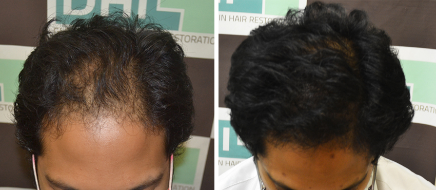 DHI before & after hair transplant results