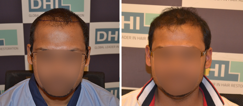 DHI before & after hair transplant results