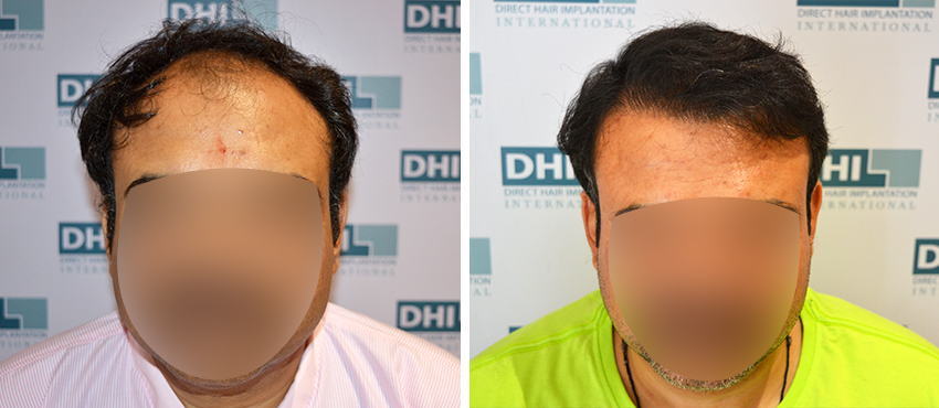 DHI before & after hair transplant results