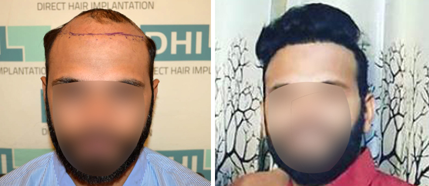 DHI before & after hair transplant results