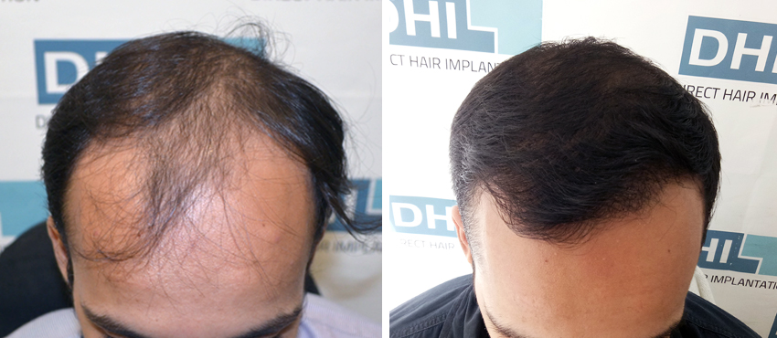 DHI before & after hair transplant results