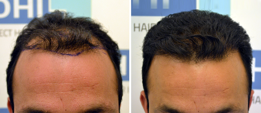 DHI before & after hair transplant results