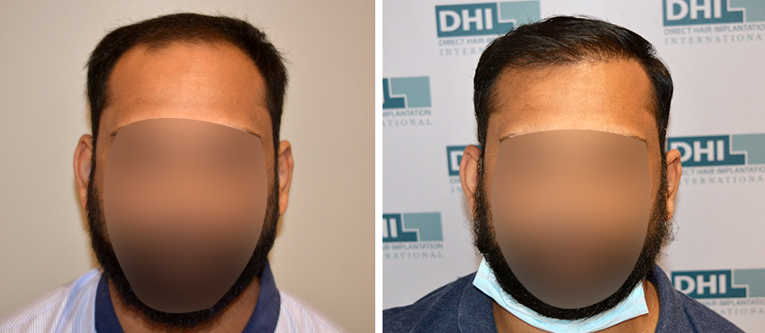 DHI before & after hair transplant results