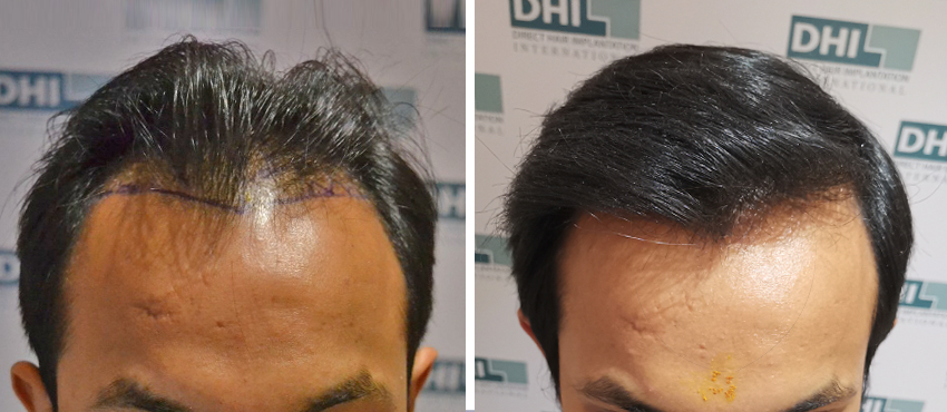 DHI before & after hair transplant results