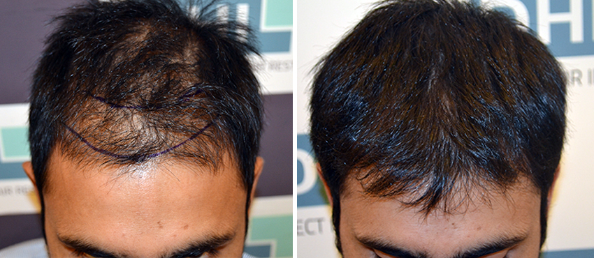 DHI before & after hair transplant results