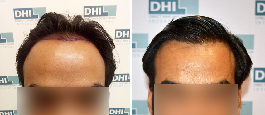 DHI before & after hair transplant results