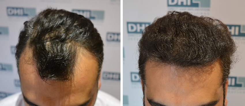 DHI before & after hair transplant results