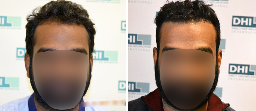 DHI before & after hair transplant results