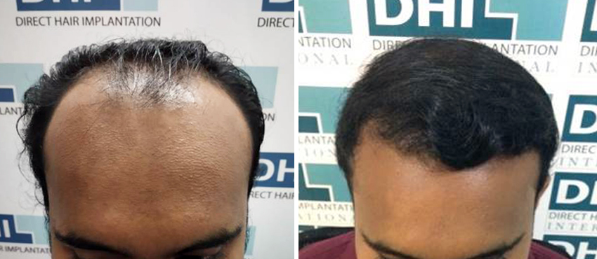 DHI before & after hair transplant results