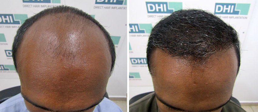 DHI before & after hair transplant results