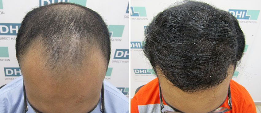 DHI before & after hair transplant results