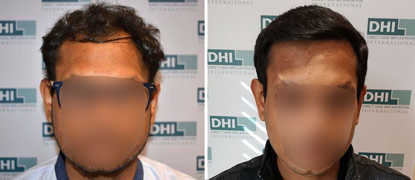 DHI before & after hair transplant results