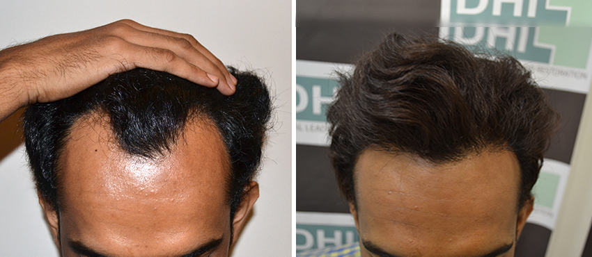 DHI before & after hair transplant results