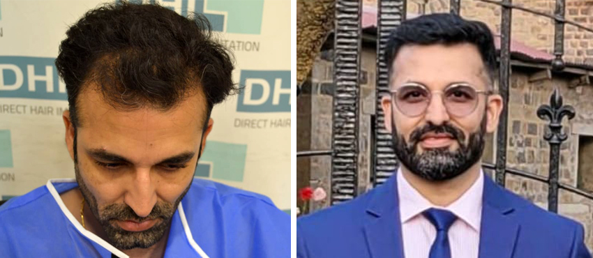 DHI before & after hair transplant results