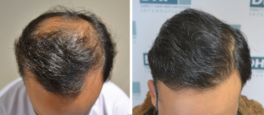 DHI before & after hair transplant results