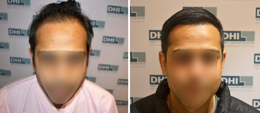 DHI before & after hair transplant results