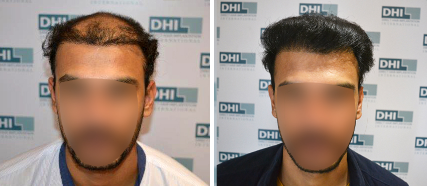 DHI before & after hair transplant results