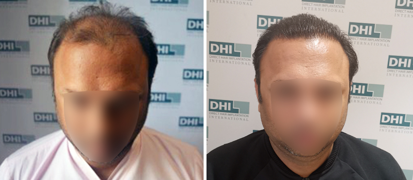 DHI before & after hair transplant results