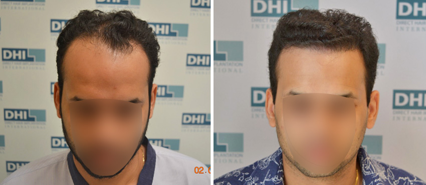 DHI before & after hair transplant results